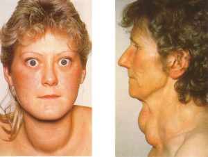 Аксонопатия в запущенной стадии. Можно ли ее вылечить?