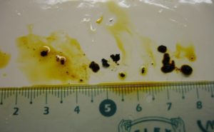 Желчь в кале