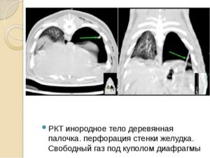 Как выявить инородное тело (деревянные палки) в мышцах?