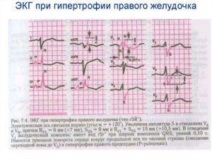 Смещение ST вниз (V5) / Отклонение параметров qrs (avr)
