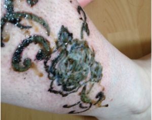 Знобит после тату