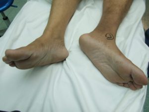 Синдром прилипшей пятки