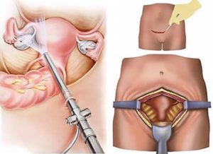 Операция по удалению матки болит низ живота после физической нагрузки