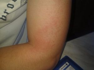 Зуд и покраснение на сгибах рук