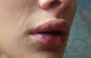 После увеличения губ появились точки