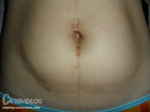 Боль в пупке после родов