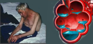 Рак 4 стадия одышка и отеки