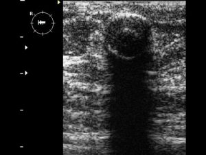 Новообразование в груди с акустической тенью