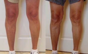 Отек внутренней стороны бедра и варикоз