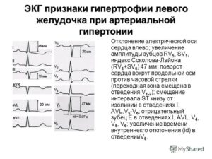Смещение ST вниз (V5) / Отклонение параметров qrs (avr)
