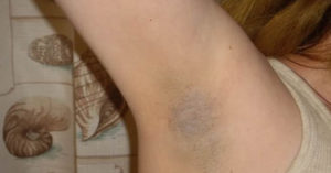 Белые пятна на подмышках