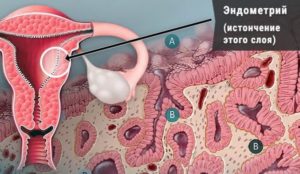 Беременность на тонком эндометрии