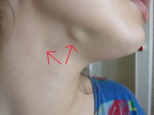 Лимфоузел под челюстью