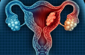 Маточное кровотечение, рак