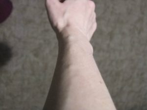 Пульсирующий шарик на вене