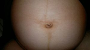 Вылез пупок во время беременности