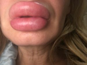 Опухла половя губа что делать?