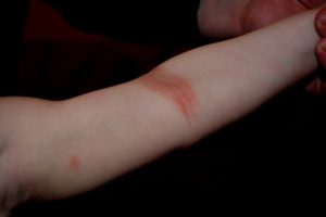 Зуд и покраснение на сгибах рук