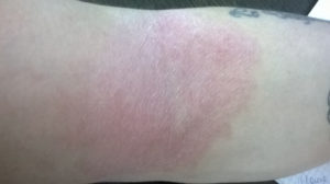 Зуд и покраснение на сгибах рук