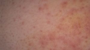 У ребенка прыщики в паху