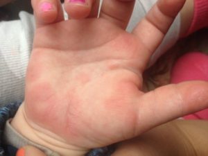 Высыпания на ступнях и ладонях, нёбе