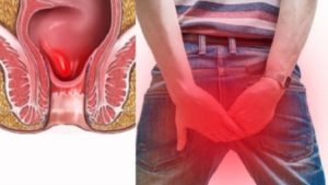 Болит задний проход, не могу больше