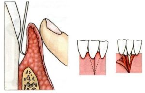 Острый край после удаления