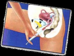 Тампон в заденем проходе! Как быть?