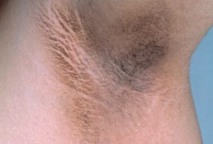 Зуд подмышками и в паху