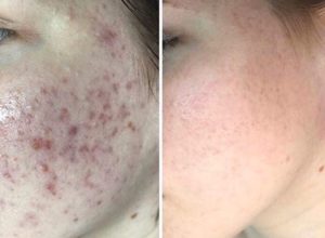 Акне 3 степени