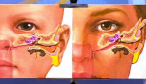 Заложенность уха после синусита