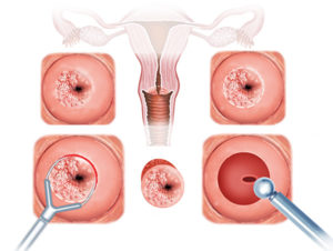 Выделения после эксцизии шейки