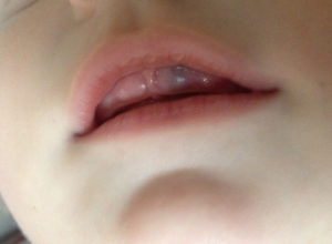 Черное пятно на десне у ребенка