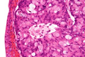 Карцинома G2