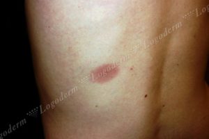 Высыпание на коже при перегибе желчного пузыря