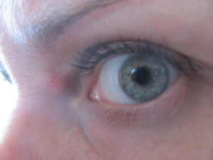 Синяк на внешнем уголке глаза