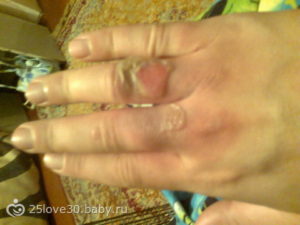 Волдыри, пузыри под гипсом, отек, синюшность