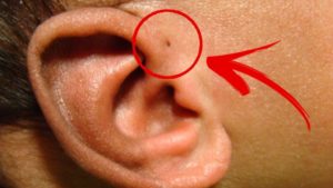 Околоушный свищ