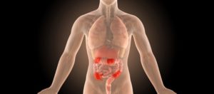 Проктосигмоидит