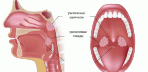 Могут ли вырасти новые миндалины