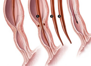 Ожог уретры