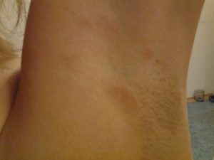 Белые пятна на подмышках