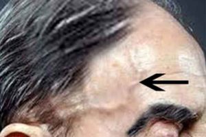 Вздутие вен на лбу