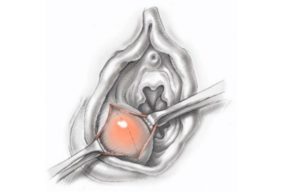 Припухлость возле входа во влагалище