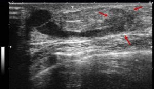 Новообразование в груди с акустической тенью