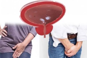 Затруднённое мочеиспускание после недели пьянки, впервые