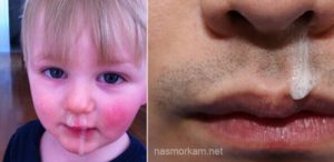 Белые сопли у ребенка