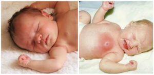 Воспалилась молочная железа у мальчика