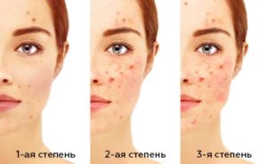 Акне 3 степени