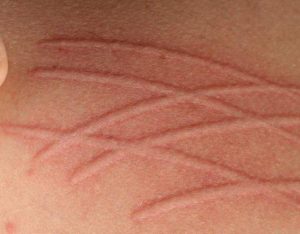 Кожа краснеет после механического прикосновения